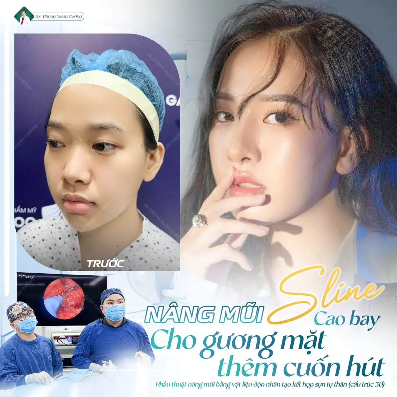 Nâng mũi bọc sụn là gì? Thông tin chi tiết bạn cần biết