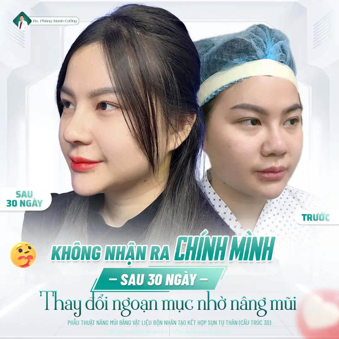 Nâng mũi bọc sụn là gì? Thông tin chi tiết bạn cần biết