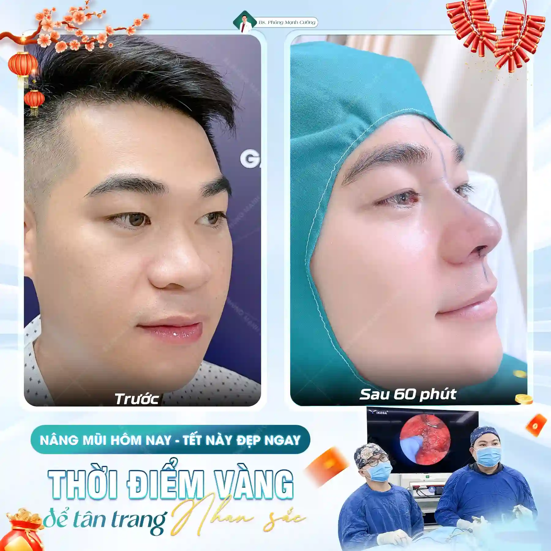 Nâng mũi bọc sụn là gì? Thông tin chi tiết bạn cần biết