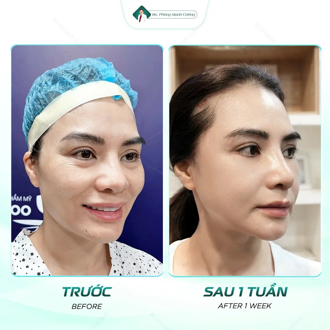 Nâng mũi bọc sụn là gì? Thông tin chi tiết bạn cần biết