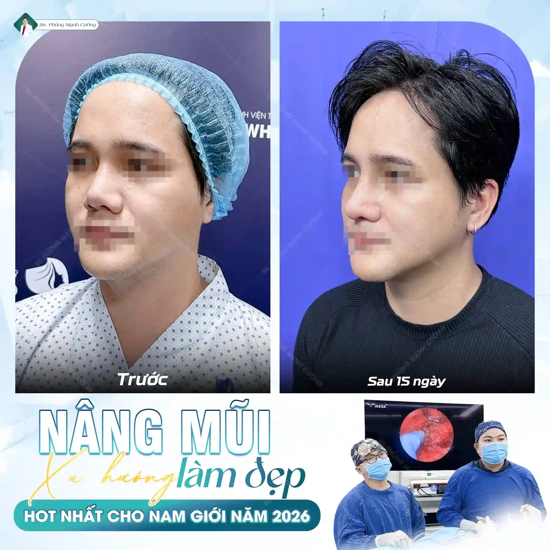 Ưu điểm của nâng mũi cấu trúc