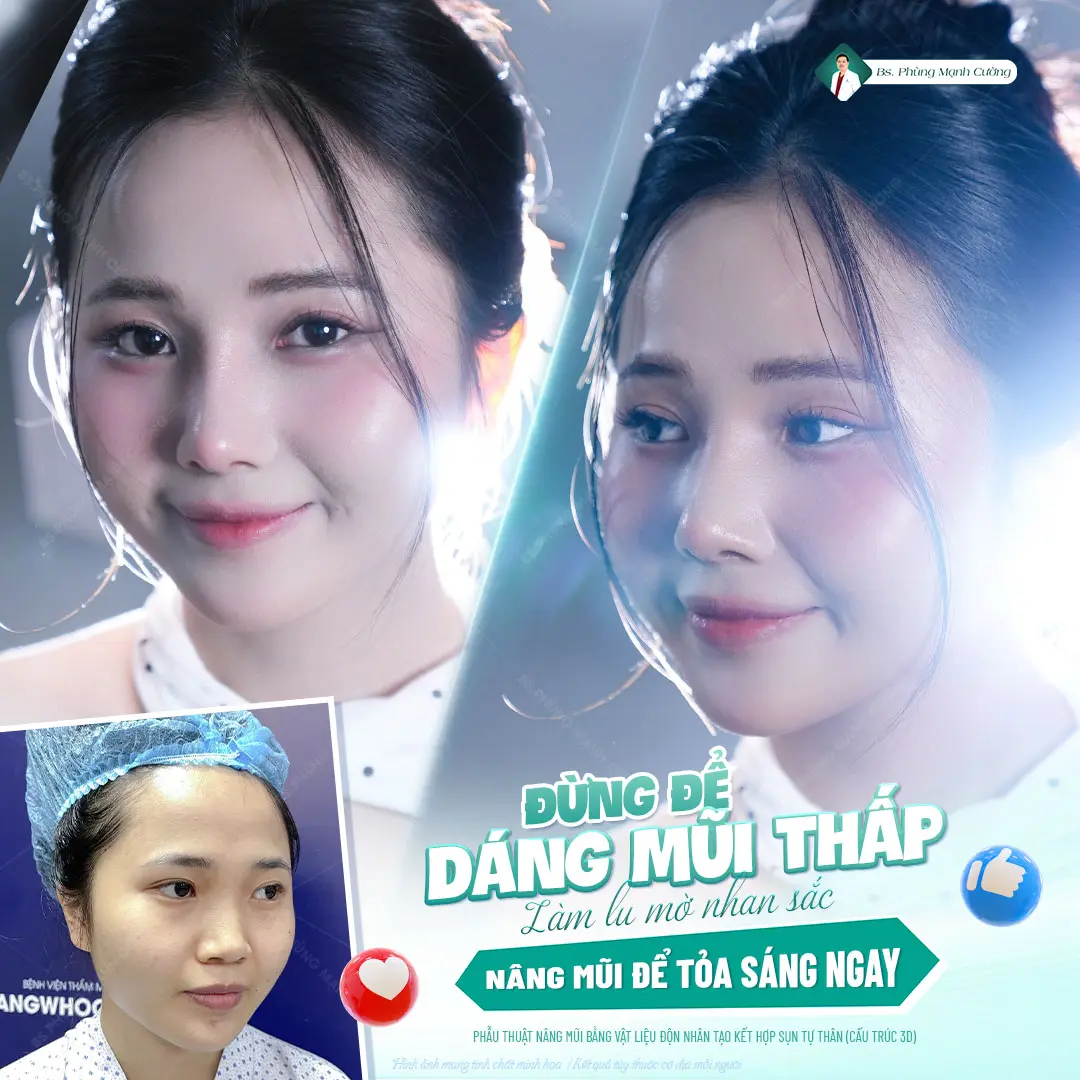 Nâng mũi cấu trúc là gì? Ưu điểm của nâng mũi cấu trúc
