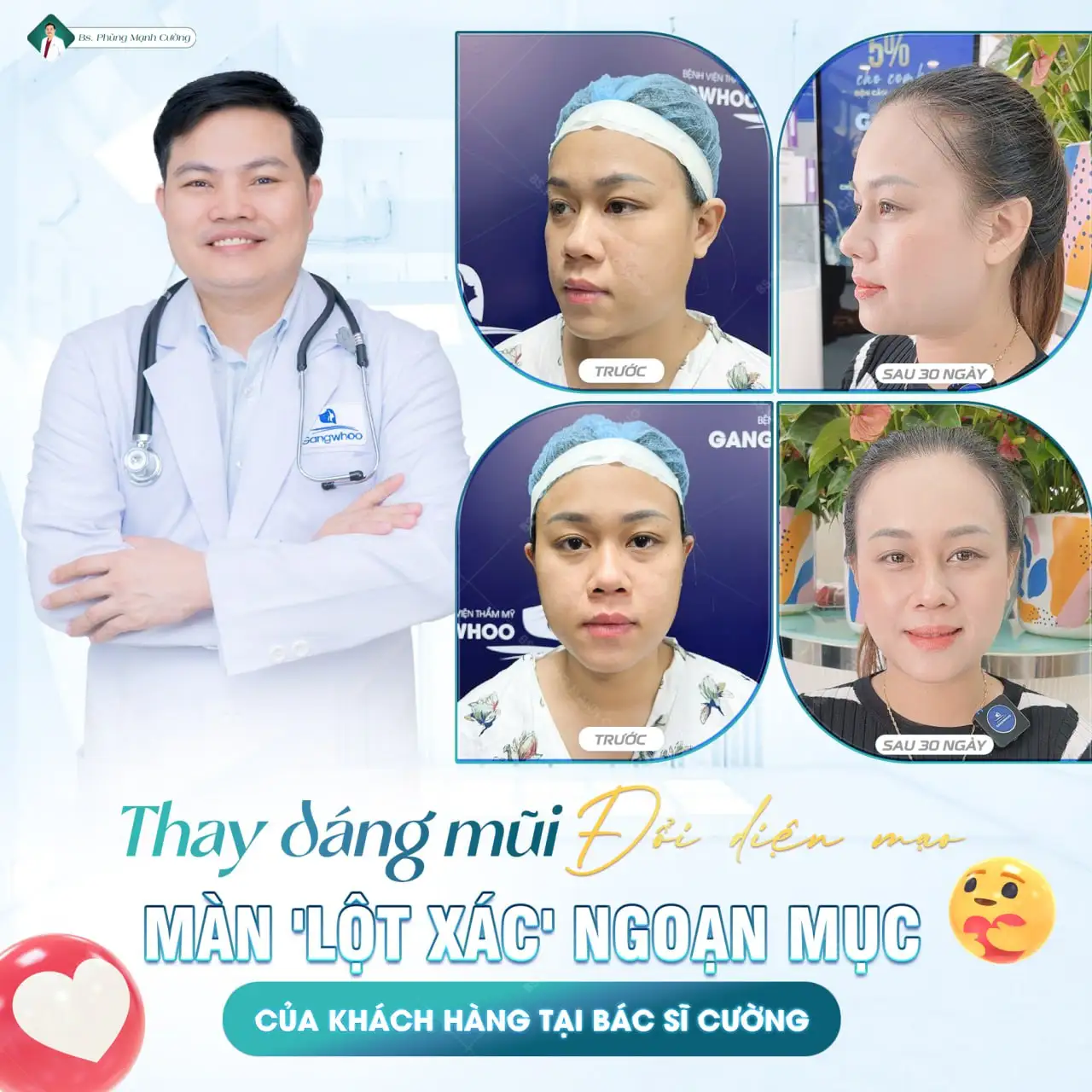 Nâng mũi cấu trúc là gì? Ưu điểm của nâng mũi cấu trúc