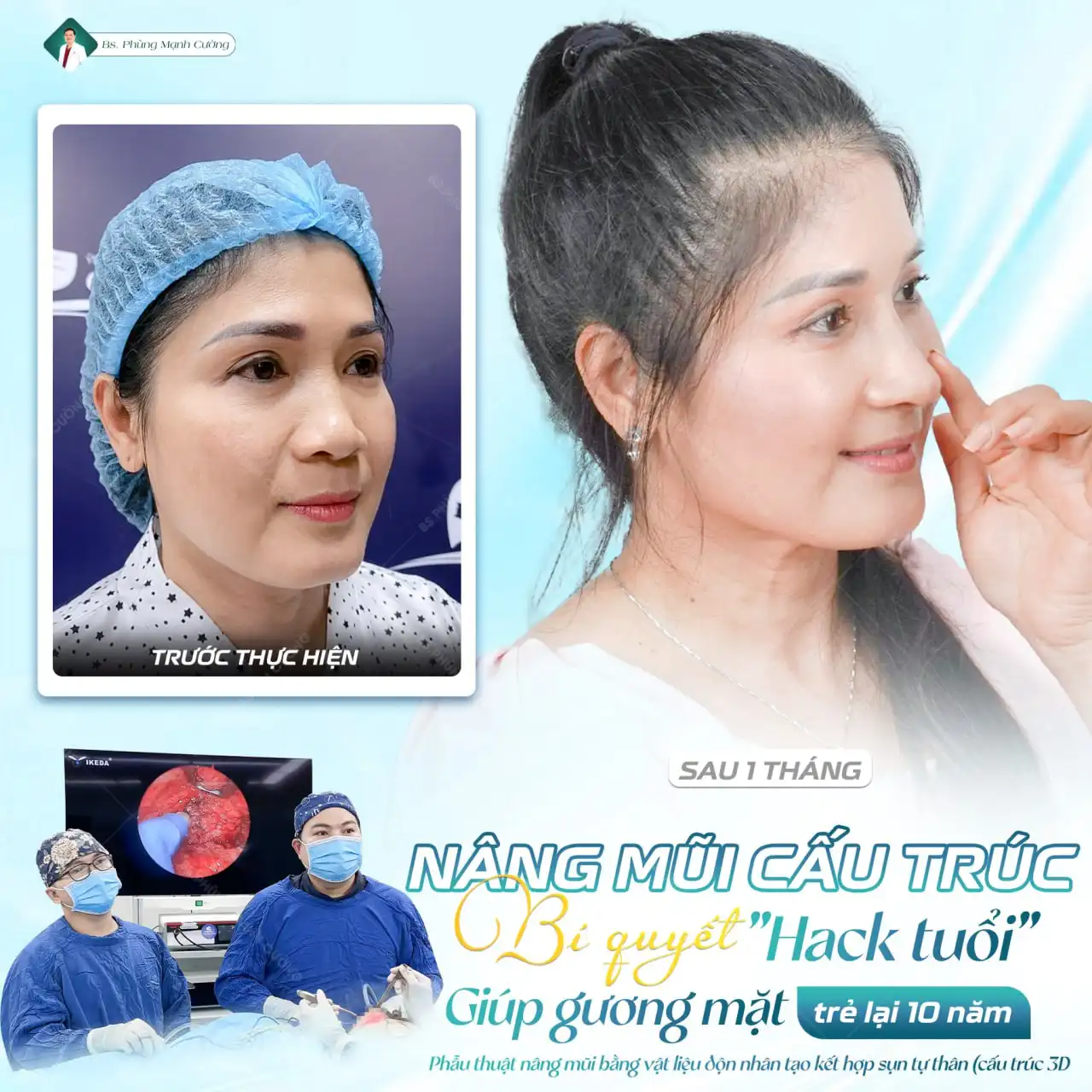 Nâng mũi cấu trúc là gì? Ưu điểm của nâng mũi cấu trúc