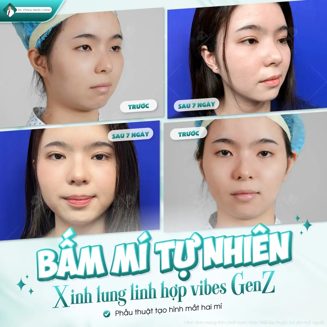 Bấm mí mắt kiểu Hàn Quốc không gây đau trong quá trình thực hiện