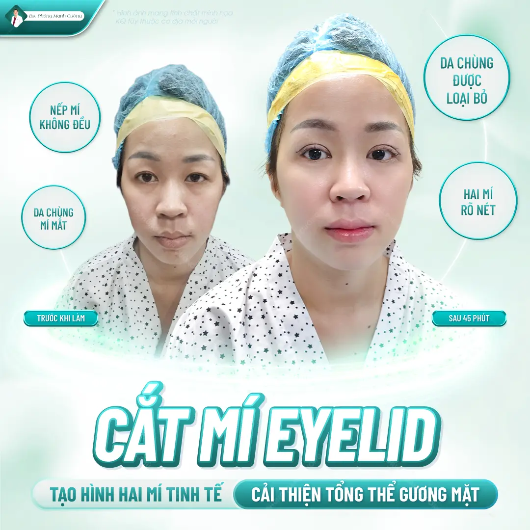 Cắt mí eyelid có nhiều ưu điểm vượt trội