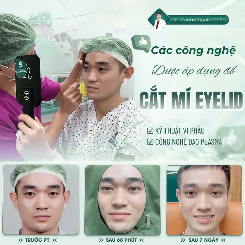 Phẫu thuật cắt mí eyelid là gì? Cắt mí eyelid giá bao nhiêu? 22 Sử dụng dao mổ plasma trong cắt mí eyelid giúp vết mổ chính xác, không đau