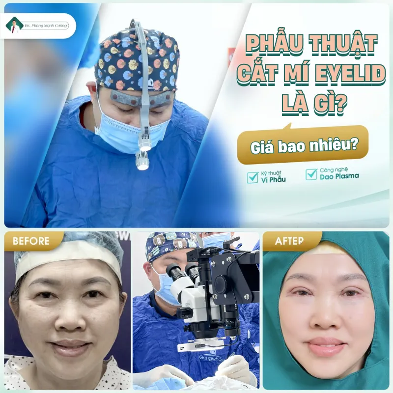 Tìm hiểu về phẫu thuật cắt mí eyelid
