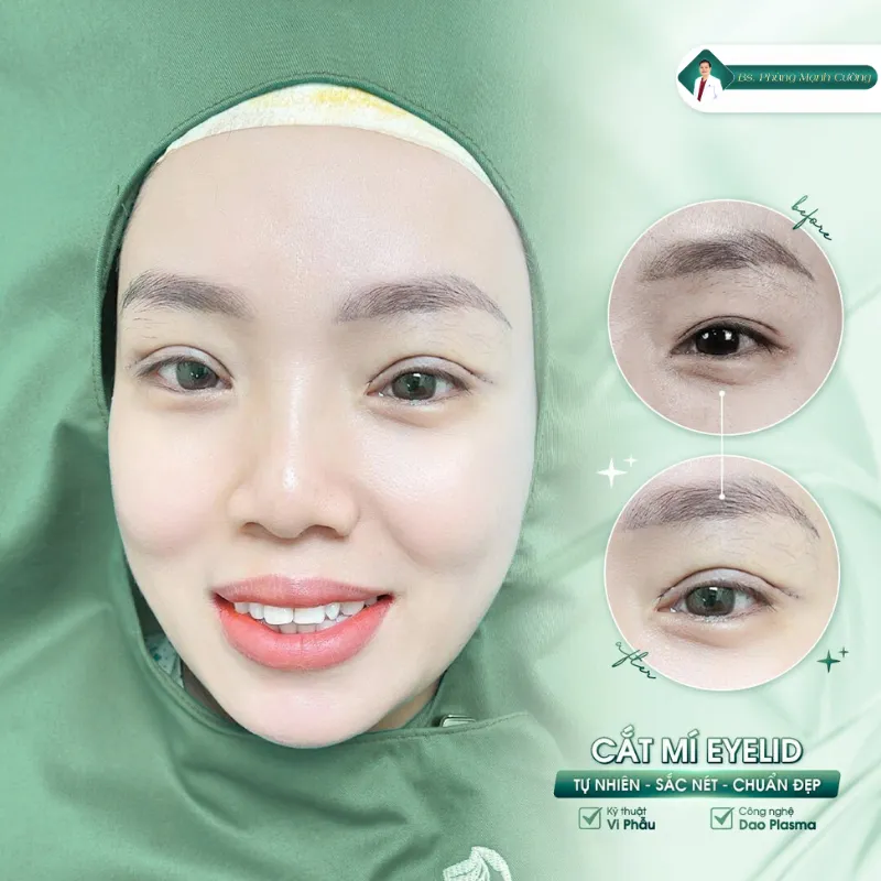 Phẫu thuật cắt mí eyelid là gì? Cắt mí eyelid giá bao nhiêu? 30 Cắt mí eyelid vào form ổn định và rõ nét sau 5-7 ngày