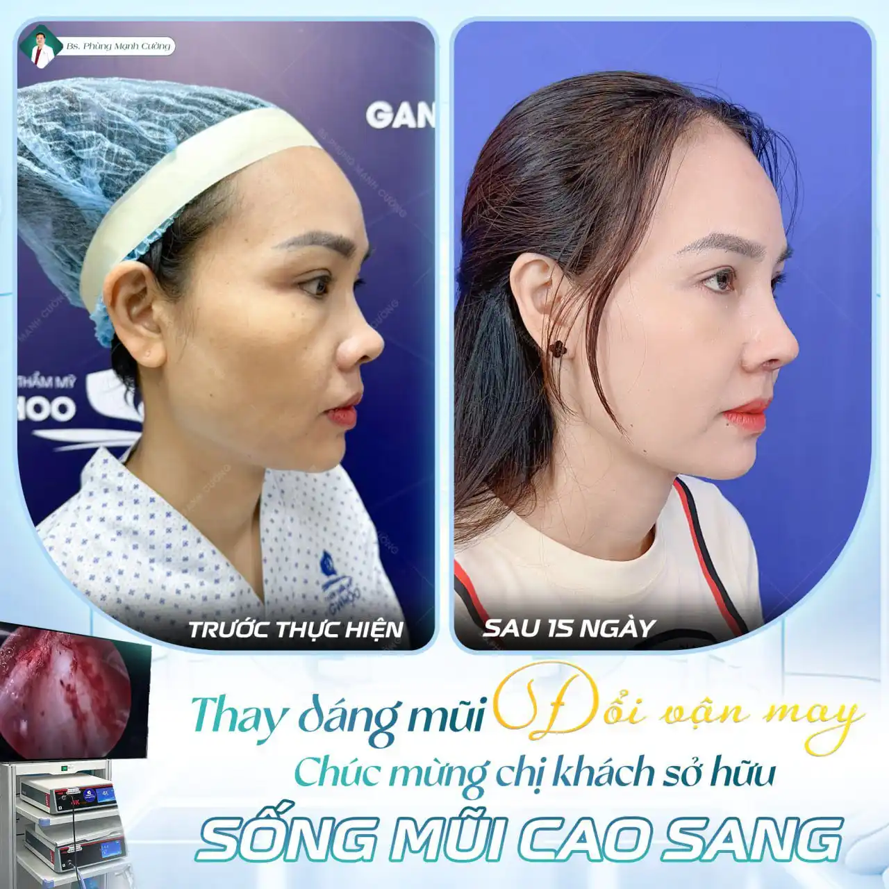 Nâng mũi Hàn Quốc​ là gì? Có nên nâng mũi Hàn Quốc không?