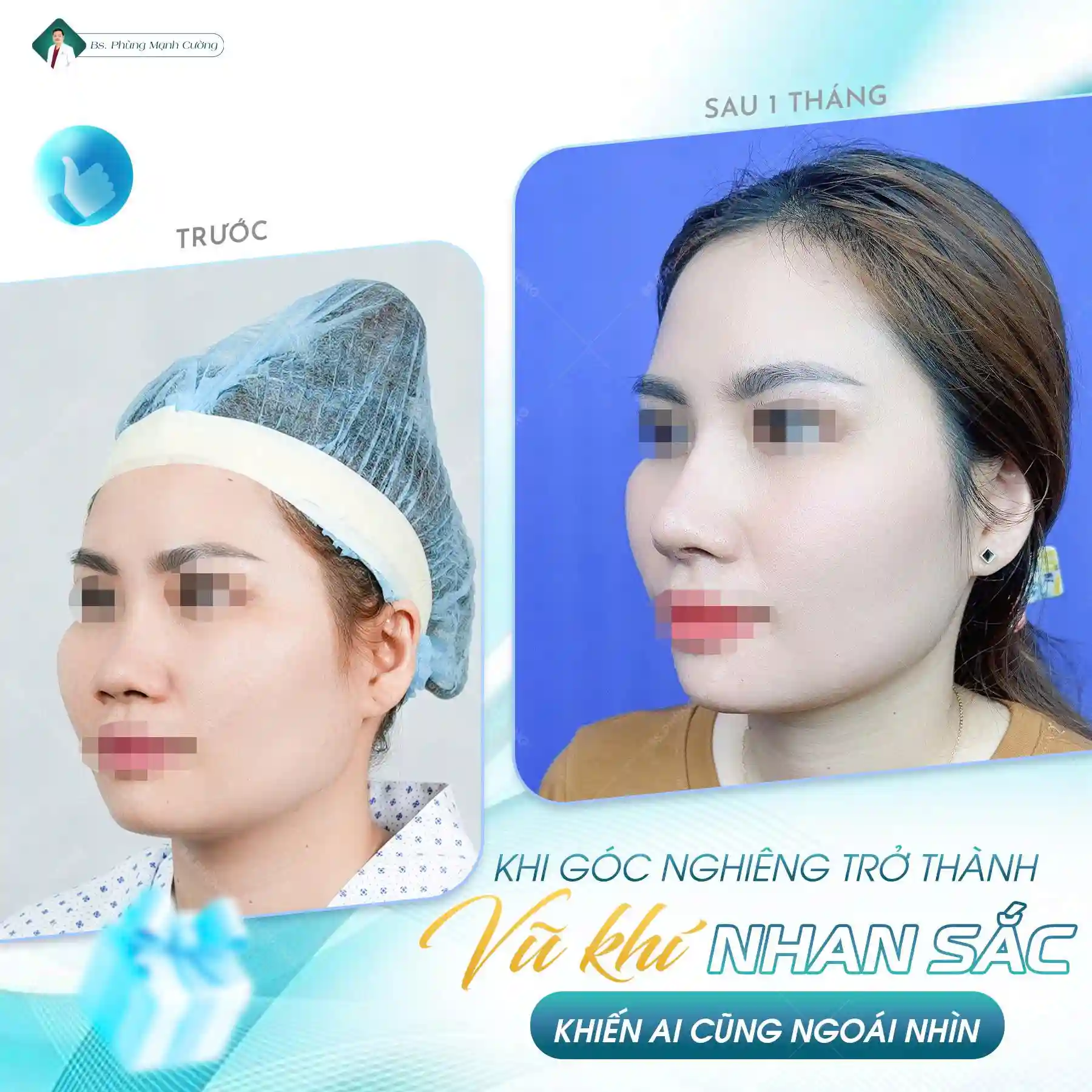 Nâng mũi Hàn Quốc là gì? Có nên nâng mũi Hàn Quốc không? 23 Ưu điểm của nâng mũi Hàn Quốc