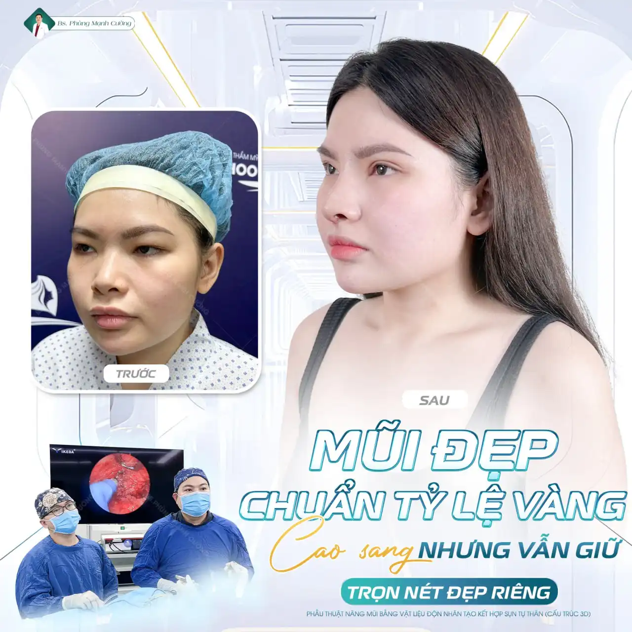 Nâng mũi Hàn Quốc​ là gì? Có nên nâng mũi Hàn Quốc không?