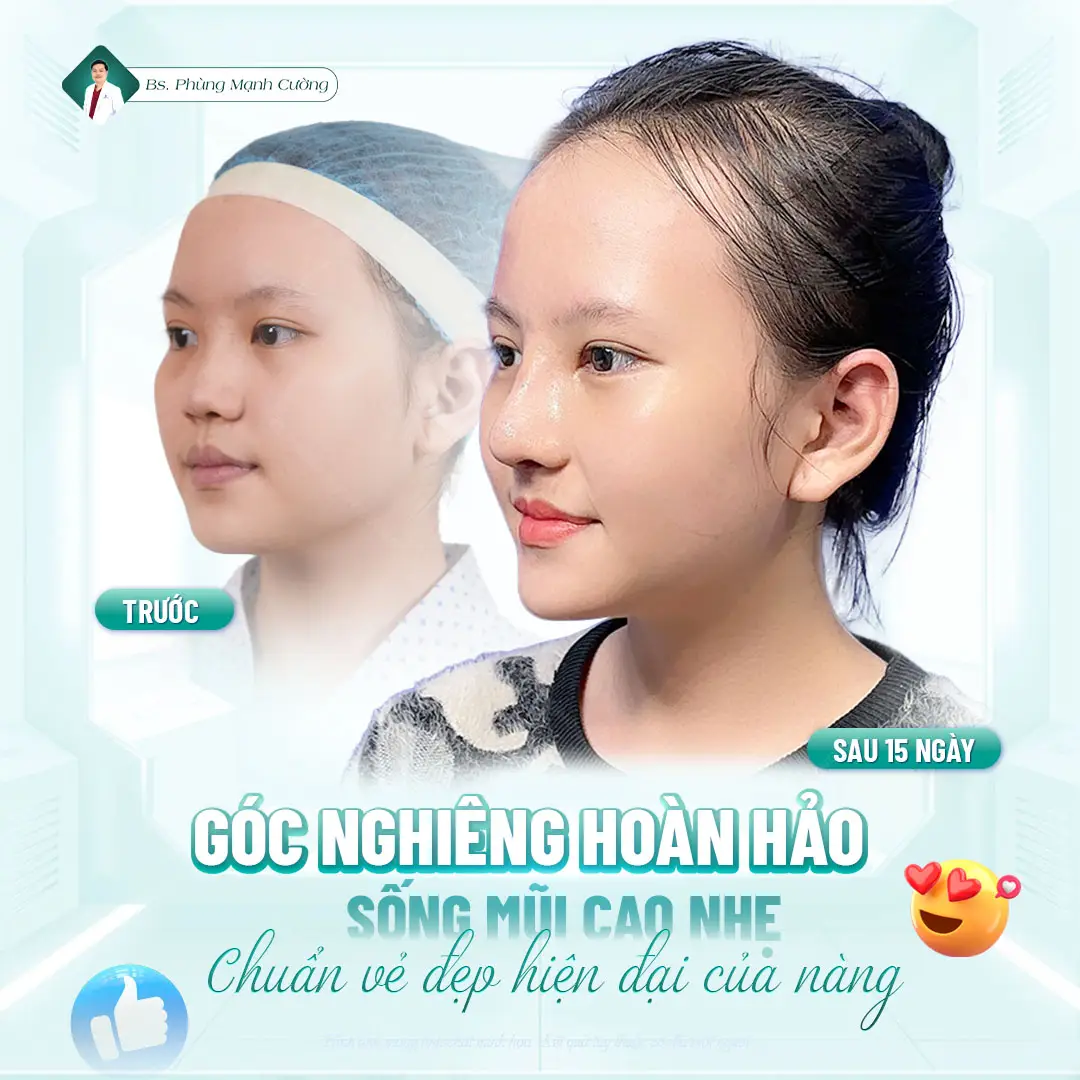 Nâng mũi Hàn Quốc là gì? Có nên nâng mũi Hàn Quốc không? 24 Những ai nên thực hiện nâng mũi Hàn Quốc