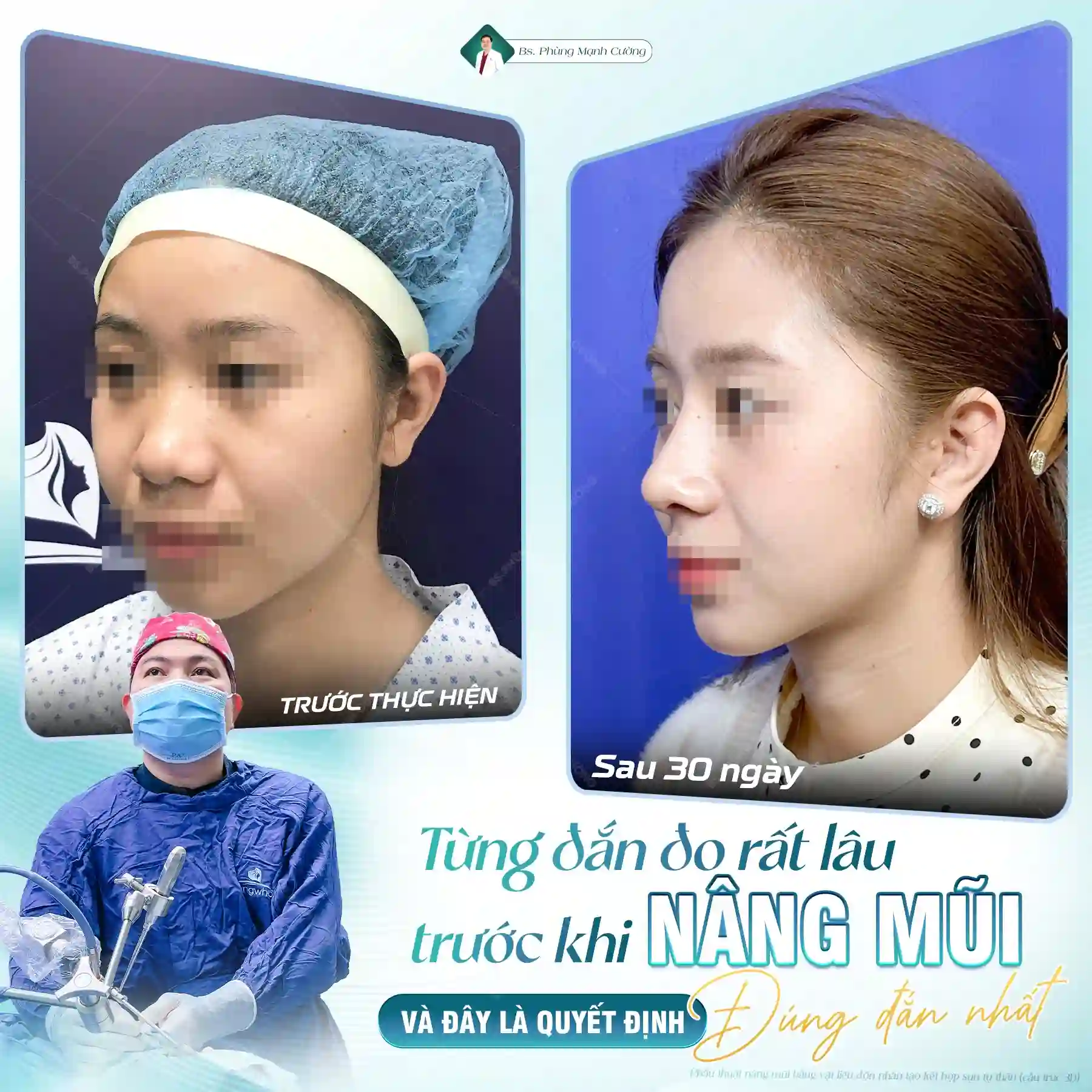 Nâng mũi Hàn Quốc​ là gì? Có nên nâng mũi Hàn Quốc không?