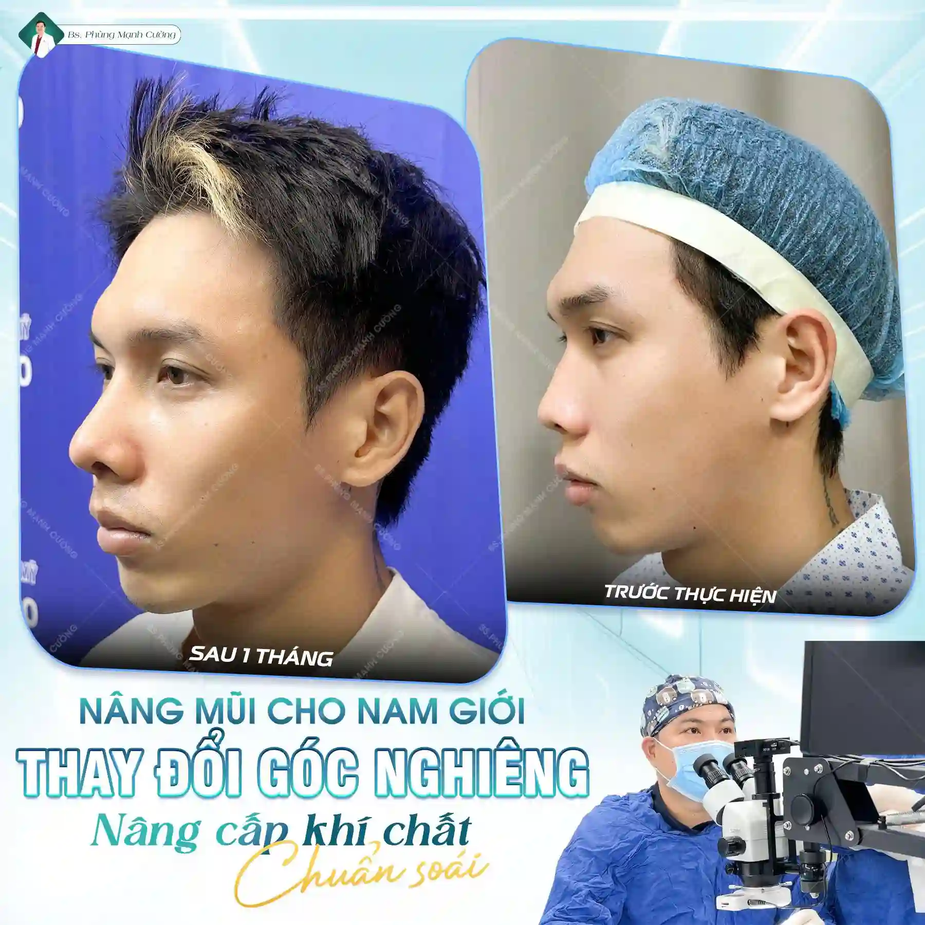 Nâng mũi Hàn Quốc là gì? Có nên nâng mũi Hàn Quốc không? 27 Nâng mũi Hàn Quốc dáng L Line cho nam tạo nên sự cá tính và mạnh mẽ