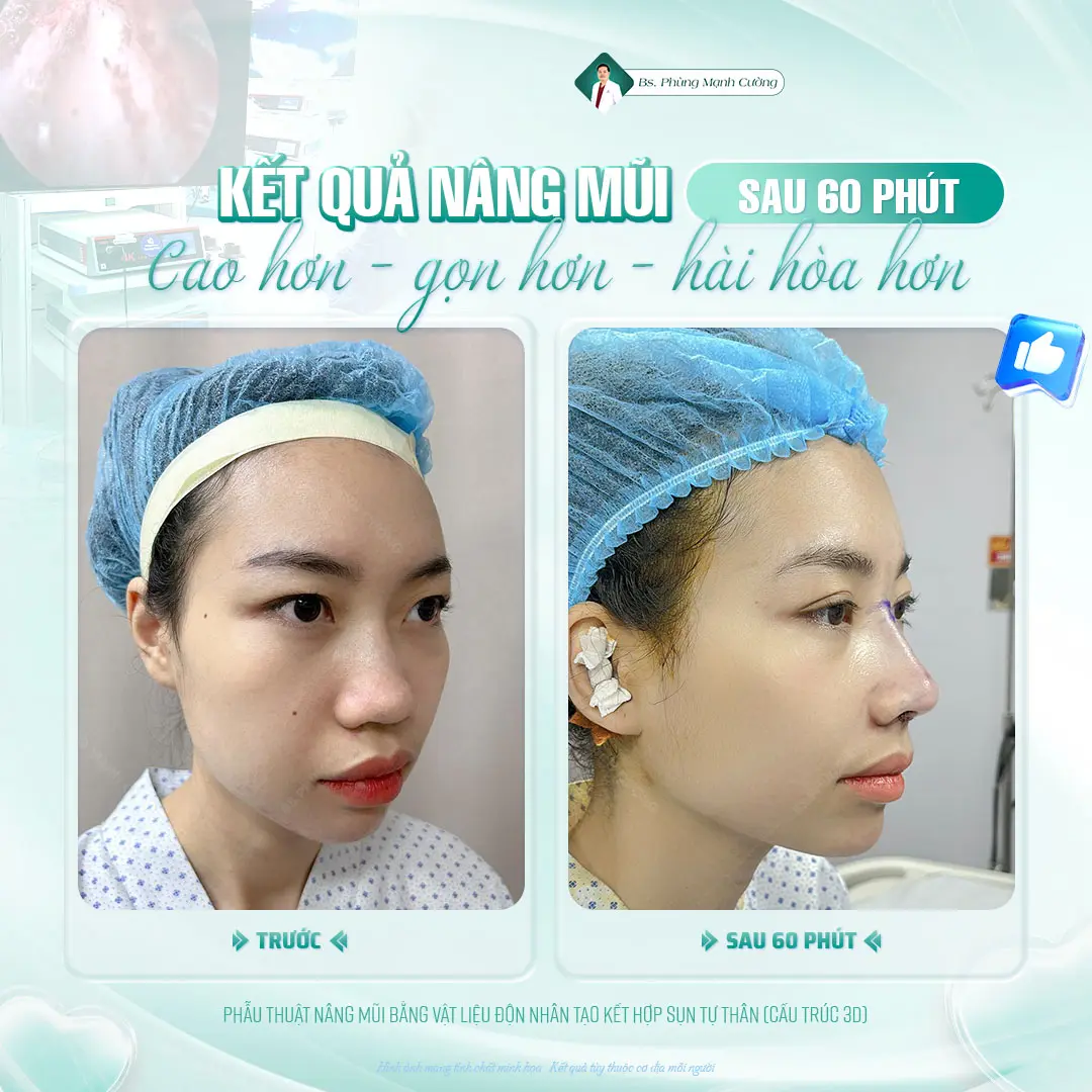 Nâng mũi Hàn Quốc​ là gì? Có nên nâng mũi Hàn Quốc không?