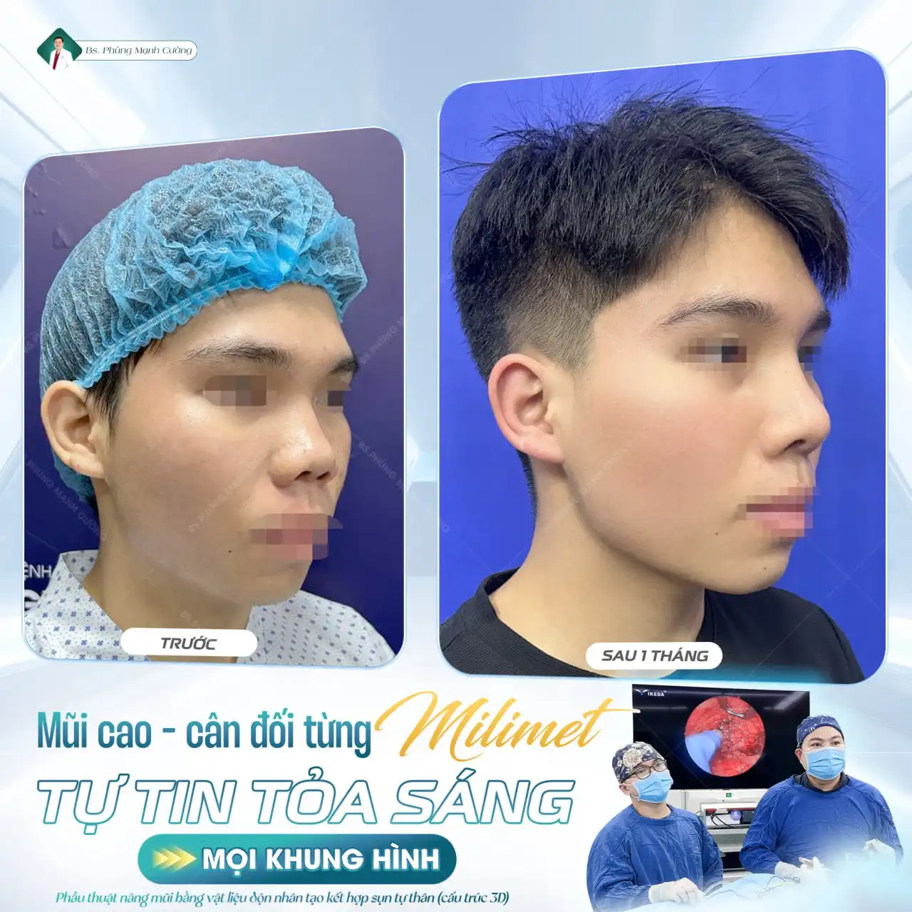 Nâng mũi Hàn Quốc dáng S Line thanh tú