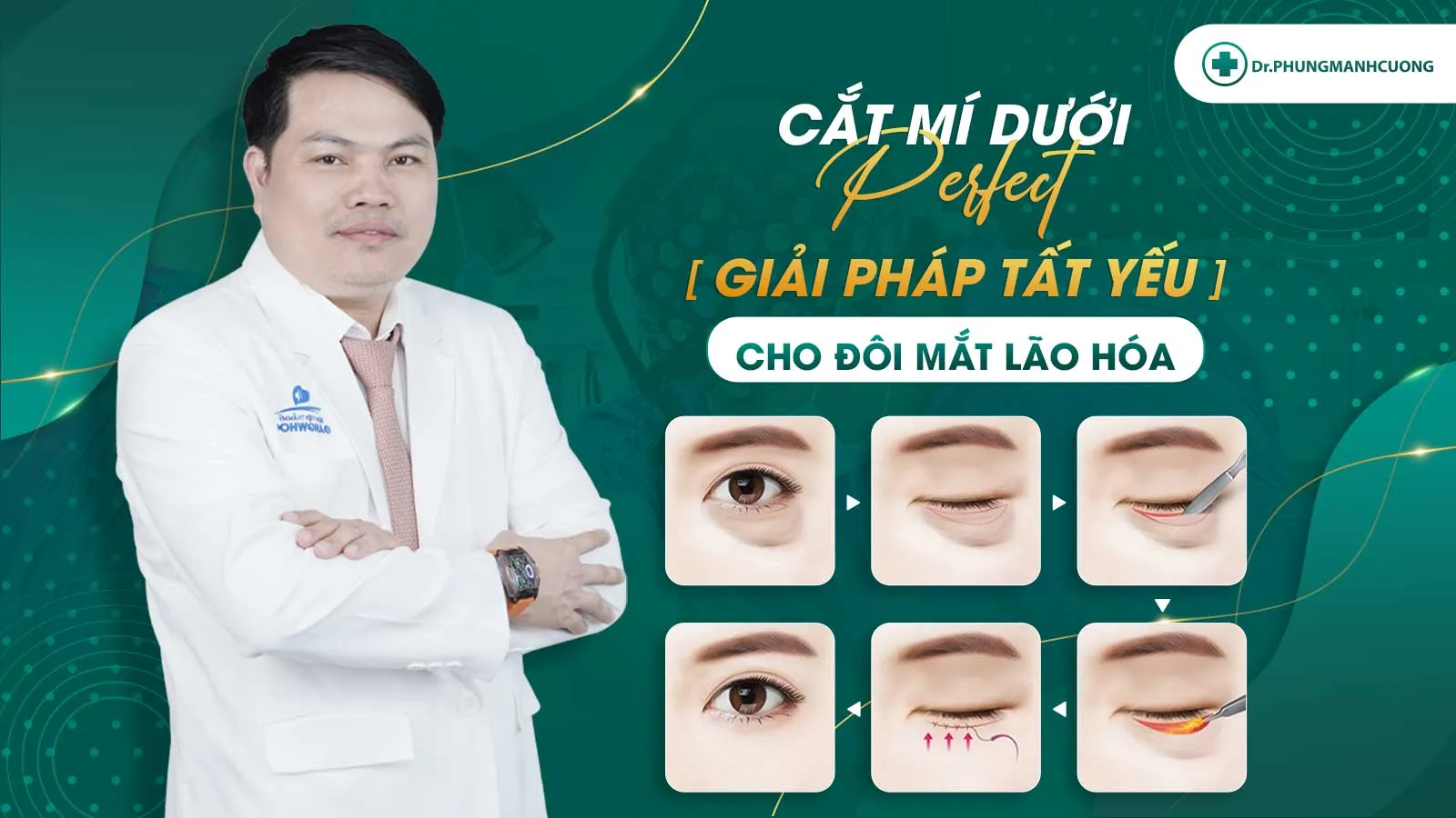 Cắt mí dưới Perfect