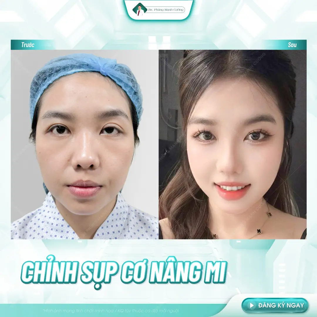 Sụp mí bẩm sinh: Nguyên nhân, dấu hiệu và cách chỉnh sụp mí