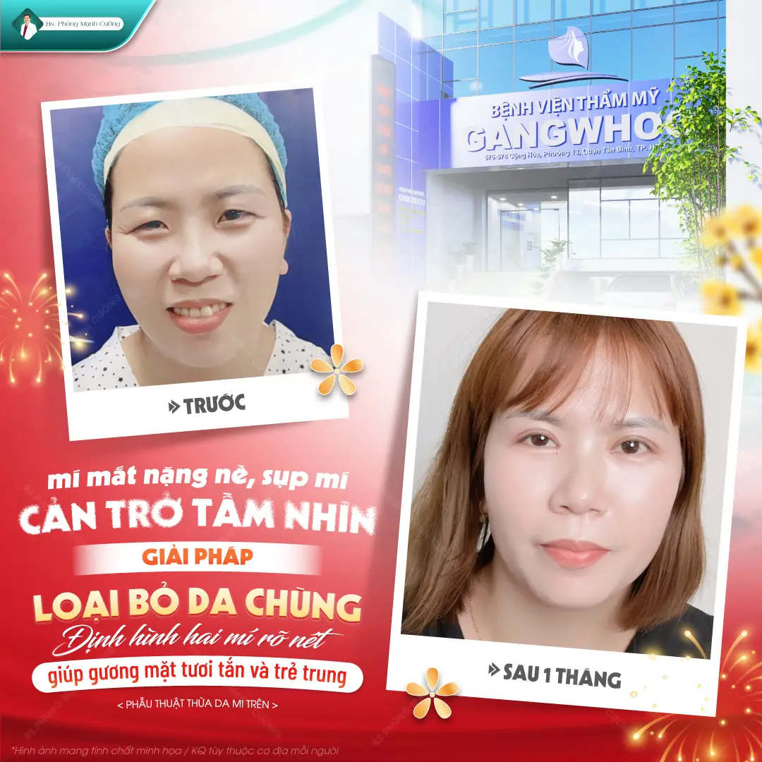 Sụp mí bẩm sinh: Nguyên nhân, dấu hiệu và cách chỉnh sụp mí