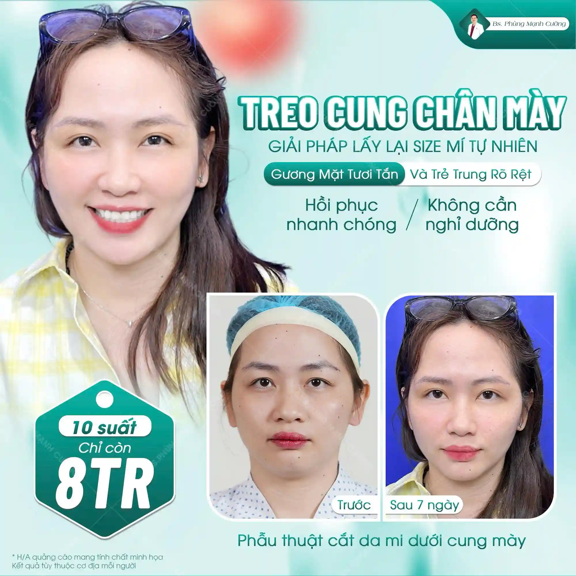 Nâng cung chân mày được thực hiện nhẹ nhàng, không đau