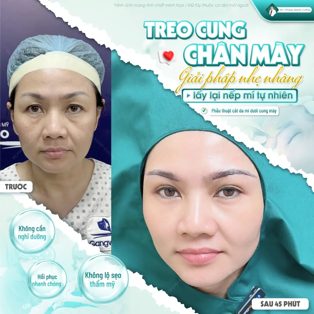 Nâng cung chân mày bằng chỉ là gì? Nâng chân mày có hiệu quả không?