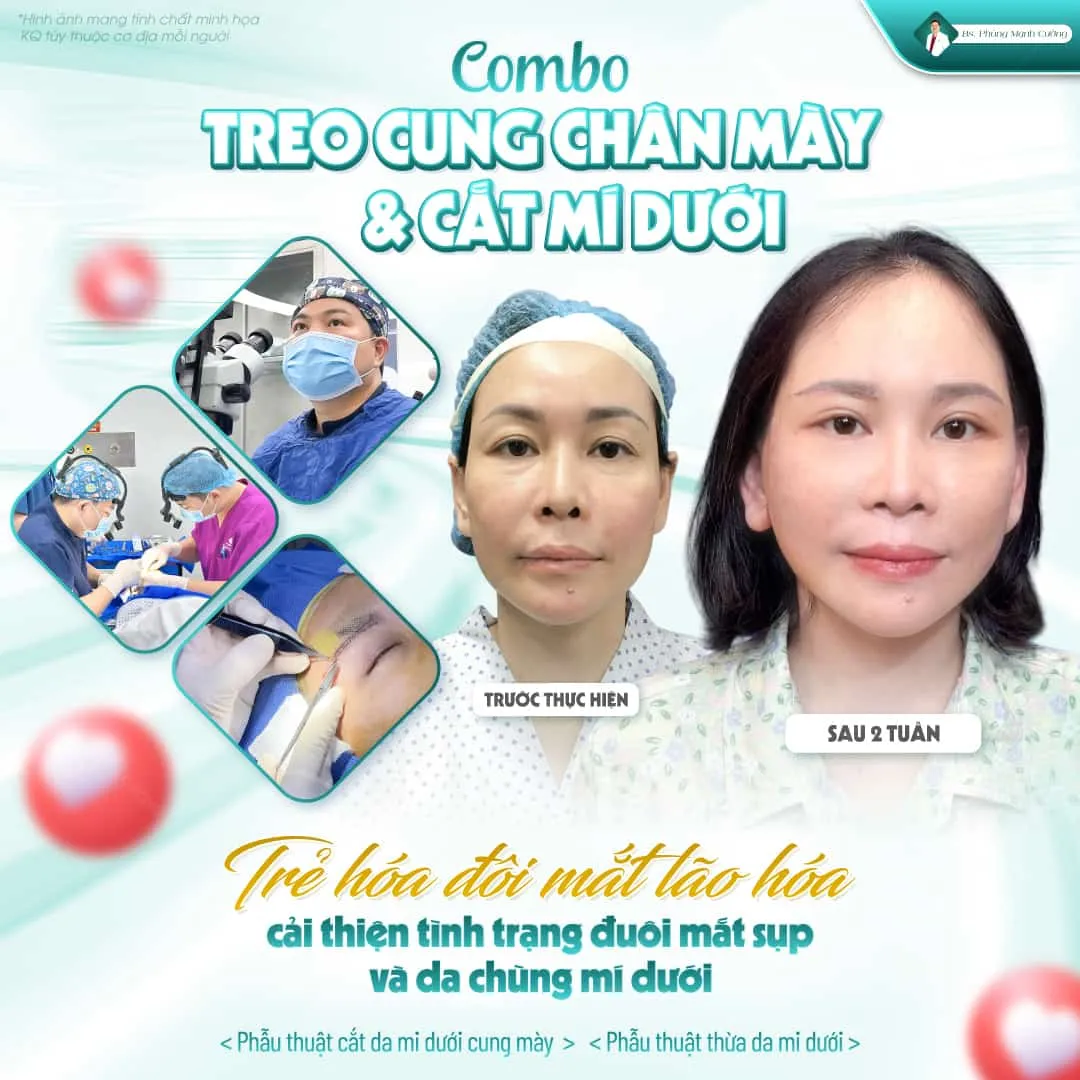 Ưu điểm khi thực hiện nâng chân mày bằng chỉ