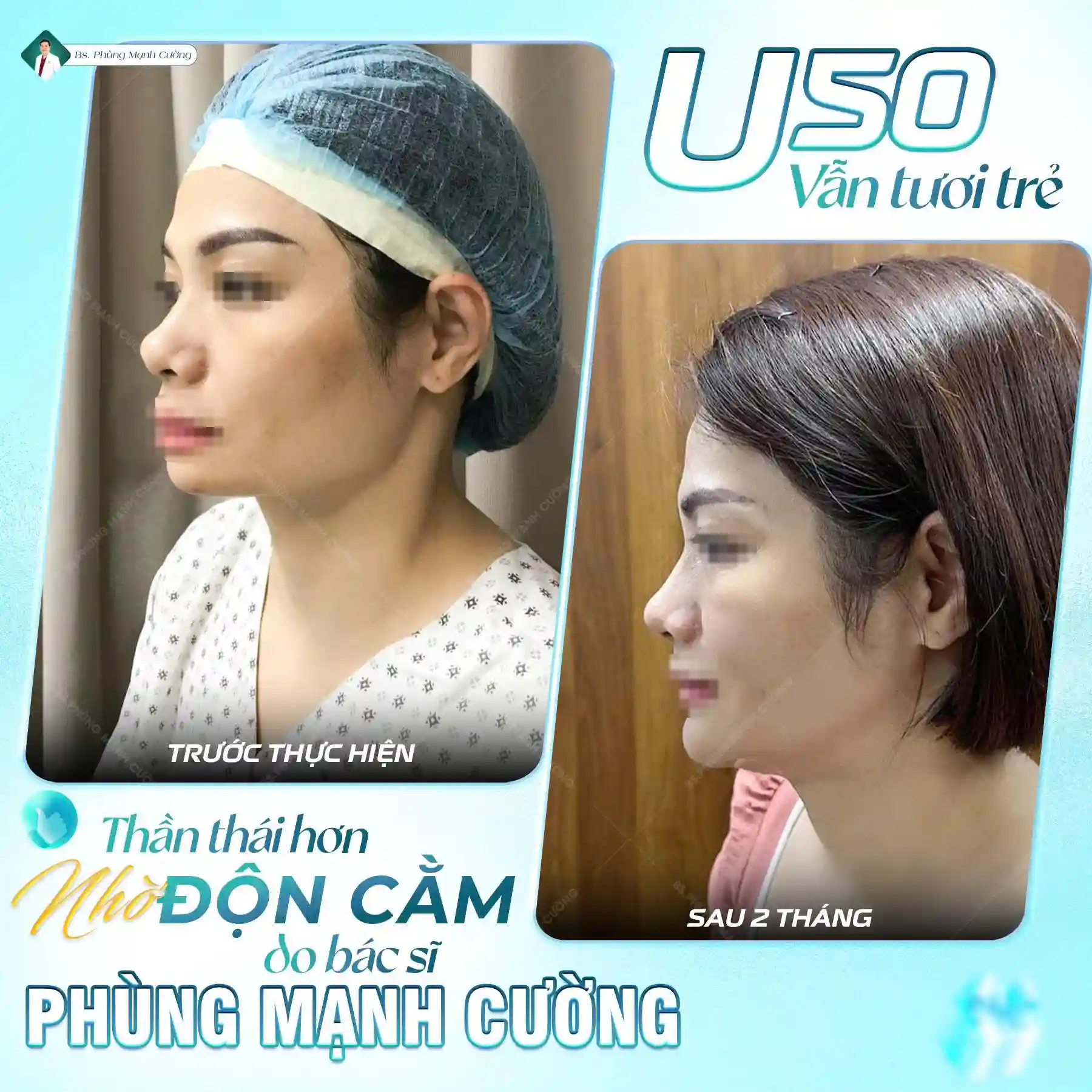 Độn Cằm Nội Soi Vi Phẫu Tại Bác Sĩ Phùng Mạnh Cường