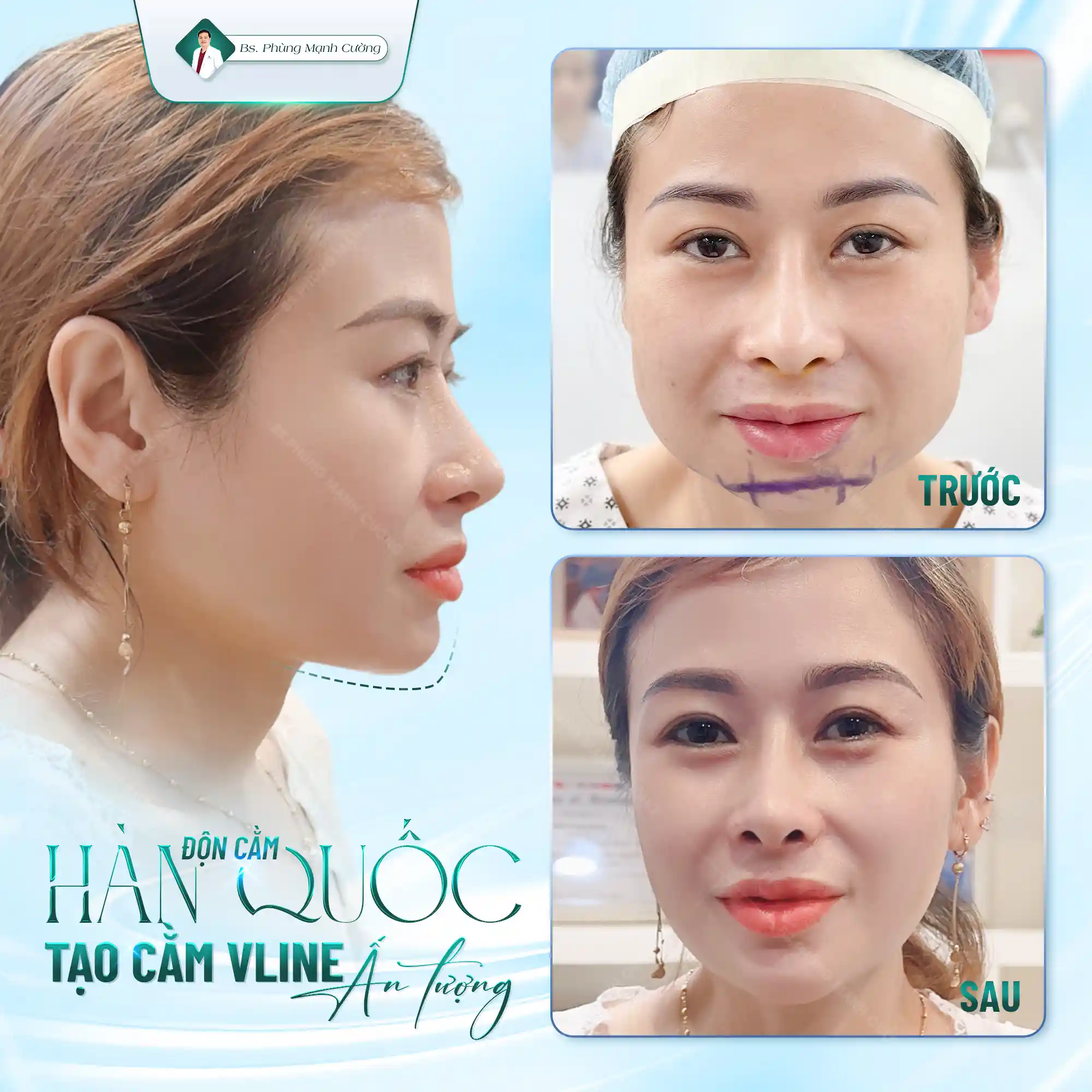 Độn Cằm Nội Soi Vi Phẫu Korea Implant – Dáng V Line Chuẩn Hàn Quốc