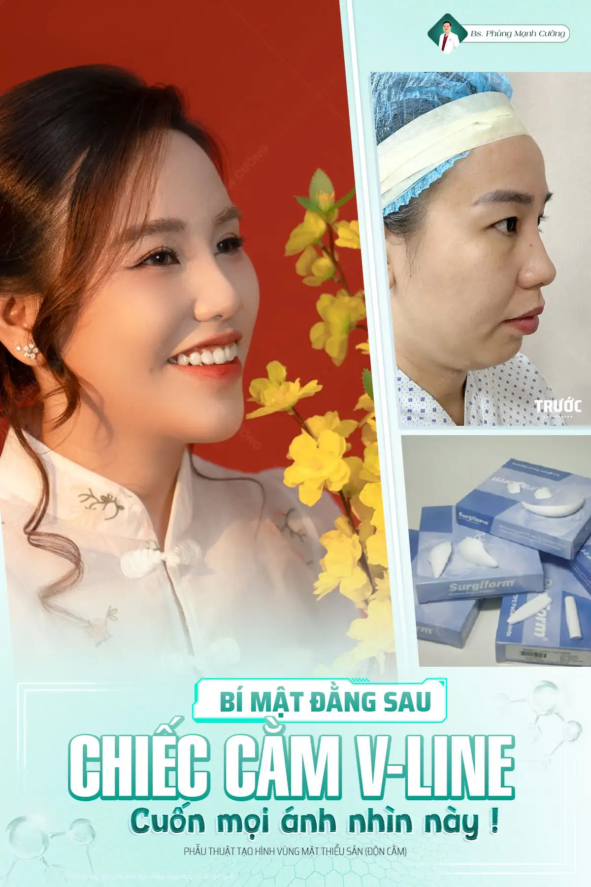 Độn Cằm Nội Soi Vi Phẫu Korea Implant – Dáng V Line Chuẩn Hàn Quốc
