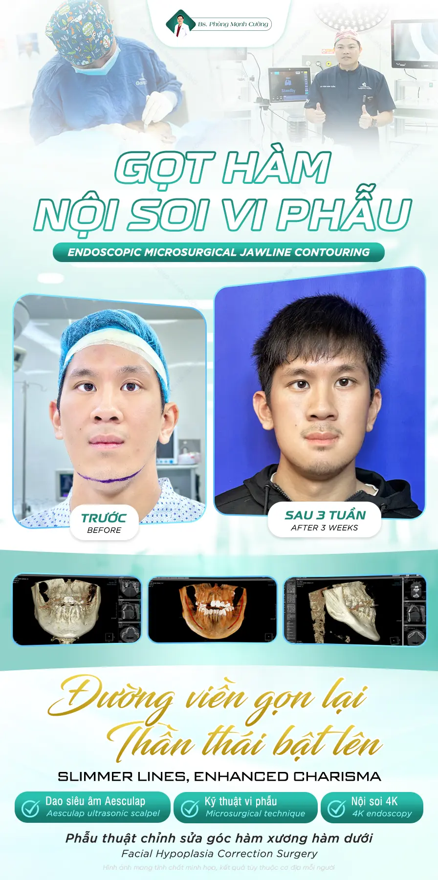 Gọt hàm V Line là gì? Những lưu ý quan trọng bạn cần biết