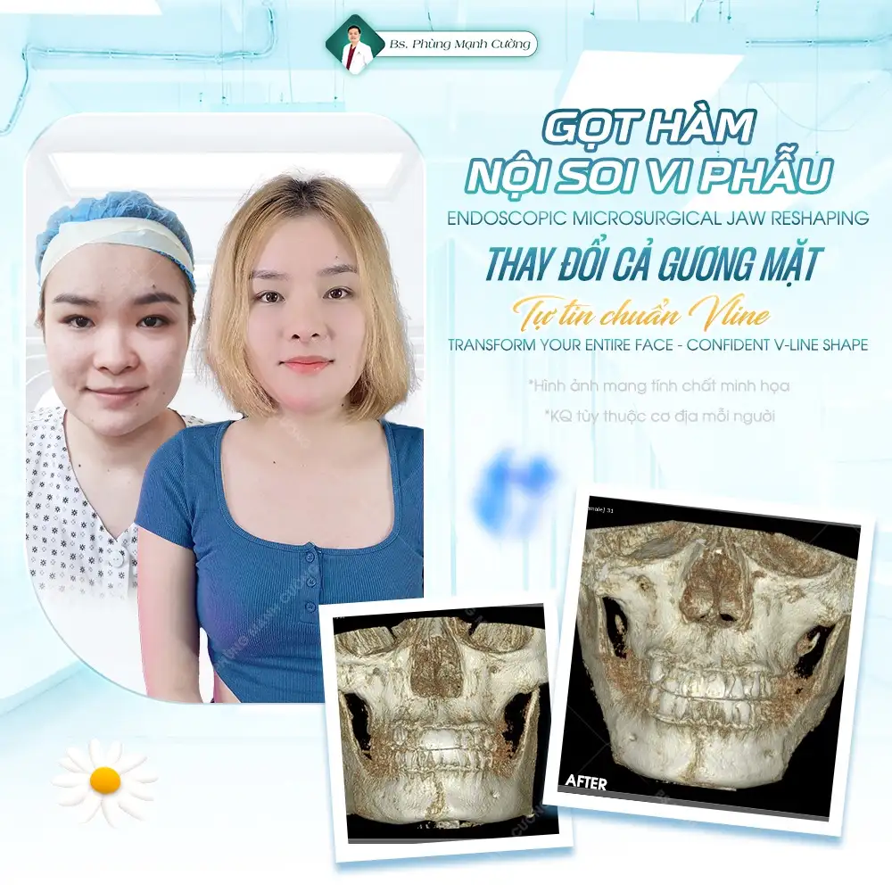 Gọt hàm V Line là gì? Những lưu ý quan trọng bạn cần biết 30 Thế nào là gọt hàm nội soi vi phẫu?