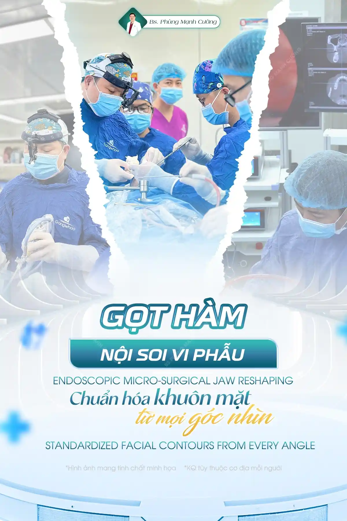 Gọt hàm V Line là gì? Những lưu ý quan trọng bạn cần biết 32 Ưu điểm của gọt hàm nội soi