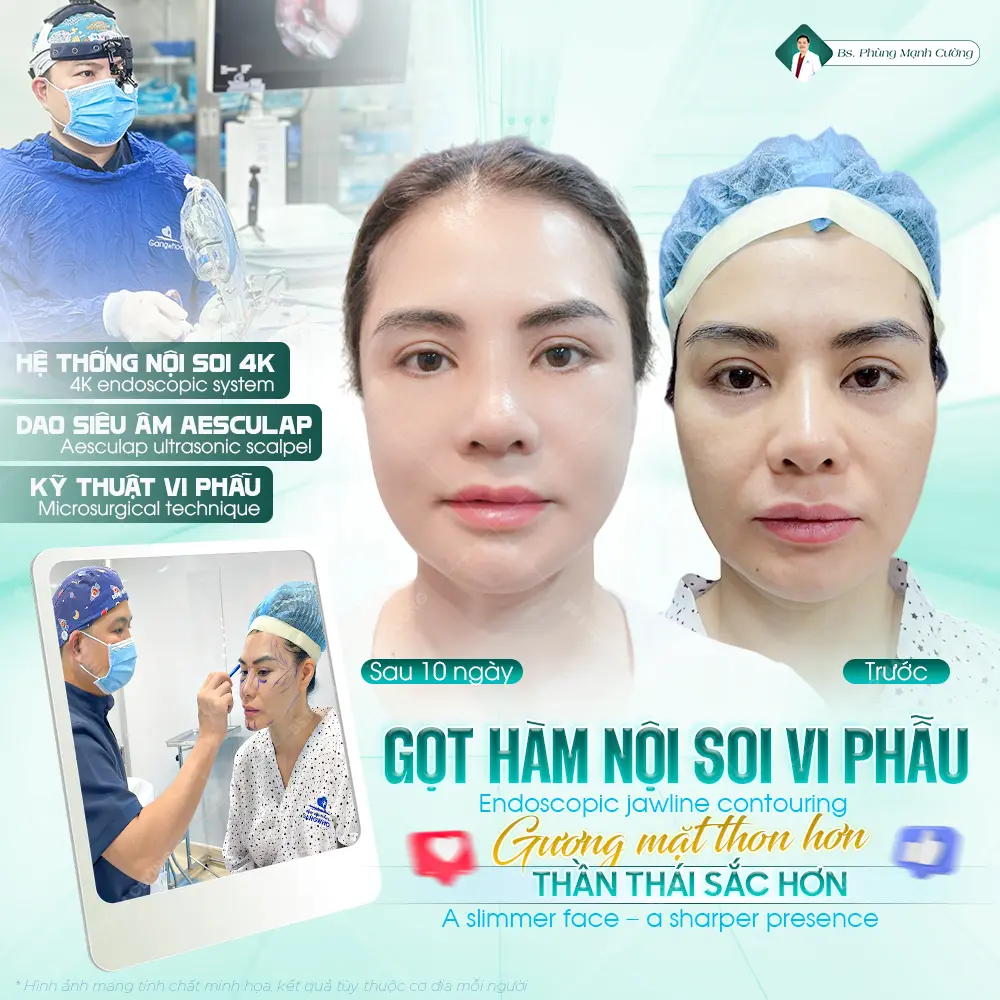 Gọt hàm V Line là gì? Những lưu ý quan trọng bạn cần biết