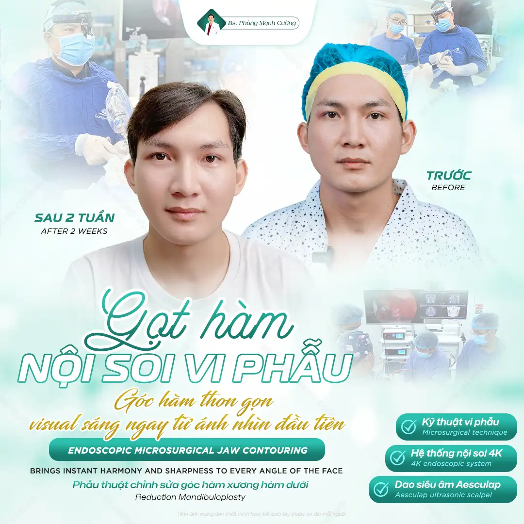 Gọt hàm V Line là gì? Những lưu ý quan trọng bạn cần biết 55 Gọt hàm V Line là gì? Những lưu ý quan trọng bạn cần biết