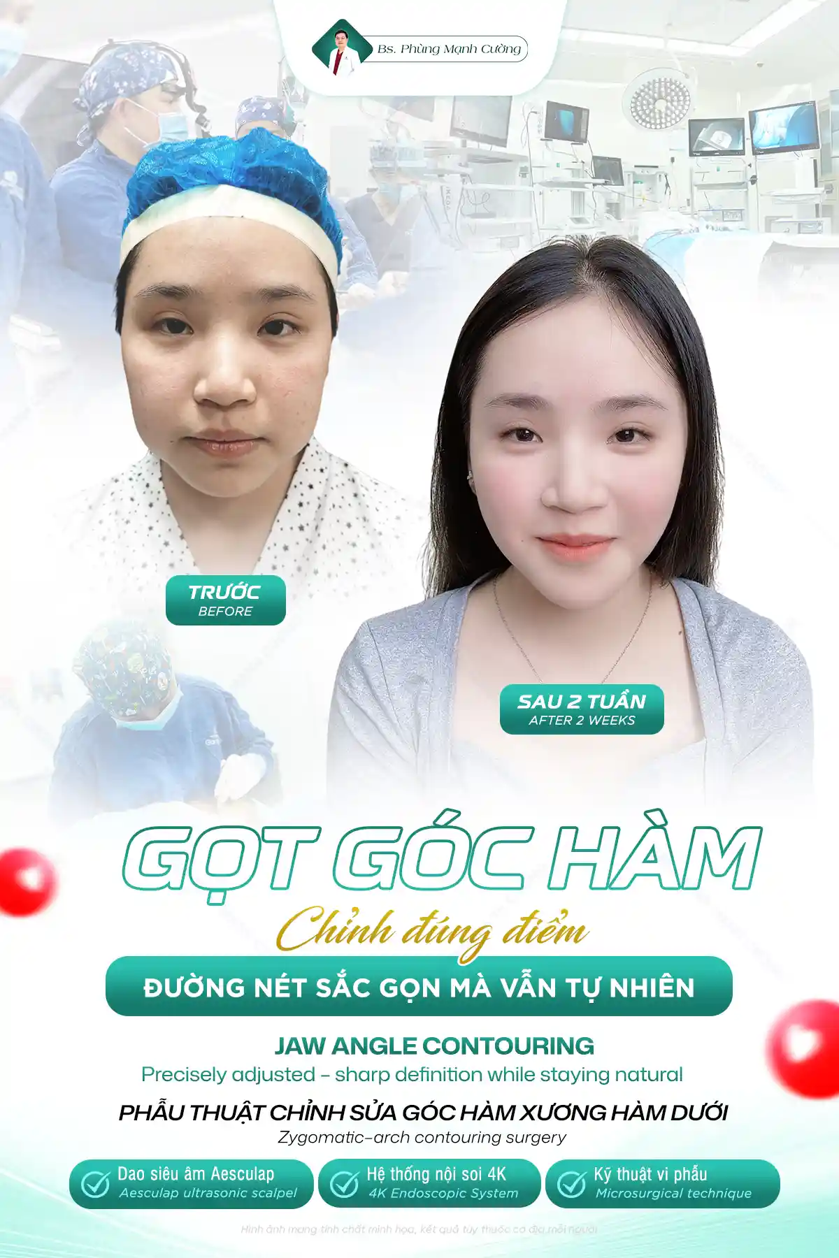 Gọt hàm V Line là gì? Những lưu ý quan trọng bạn cần biết 53 Gọt hàm V Line là gì? Những lưu ý quan trọng bạn cần biết