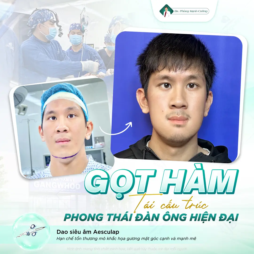 Gọt hàm V Line là gì? Những lưu ý quan trọng bạn cần biết 31 Những trường hợp nên thực hiện phẫu thuật chỉnh góc xương hàm dưới