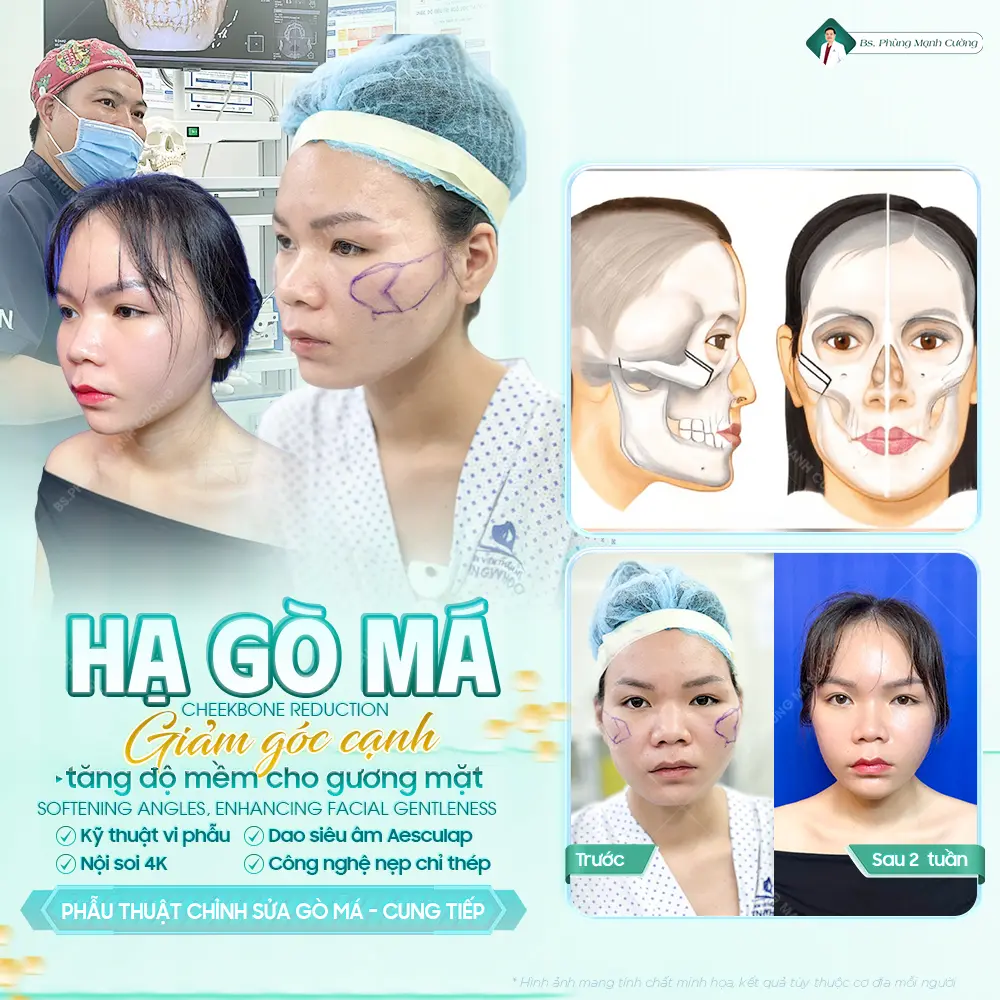 Phẫu thuật hạ gò má là gì? Có nên thực hiện không? 26 Kết quả hạ gò má thường ổn định từ 1 đến 3 tháng