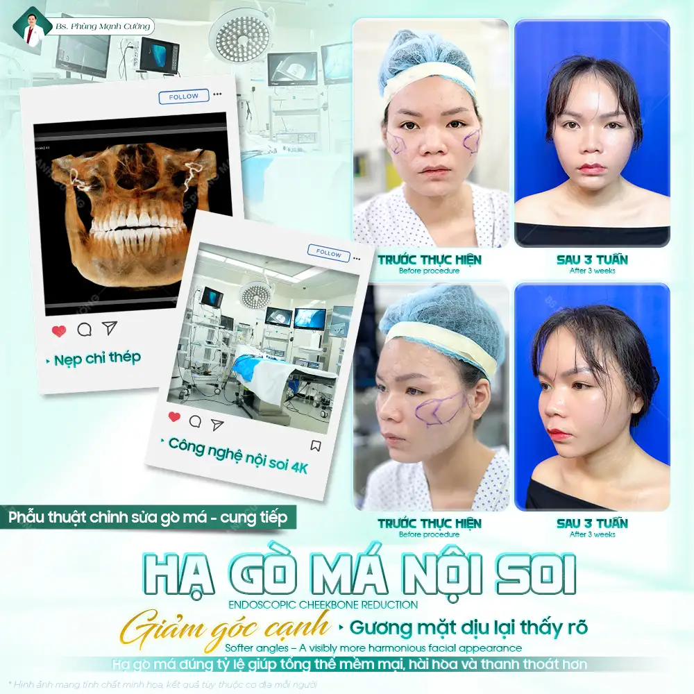 Phẫu thuật hạ gò má là gì? Có nên thực hiện không? 23 Tìm hiểu về phẫu thuật hạ gò má