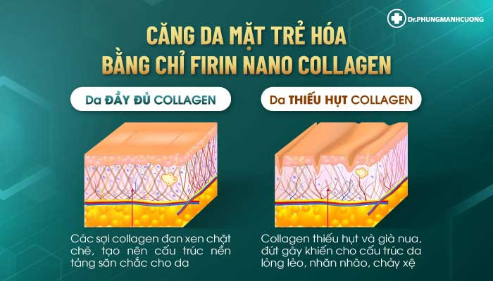 Căng da mặt bằng chỉ Firrin Nano Collagen giúp tăng sinh collagen
