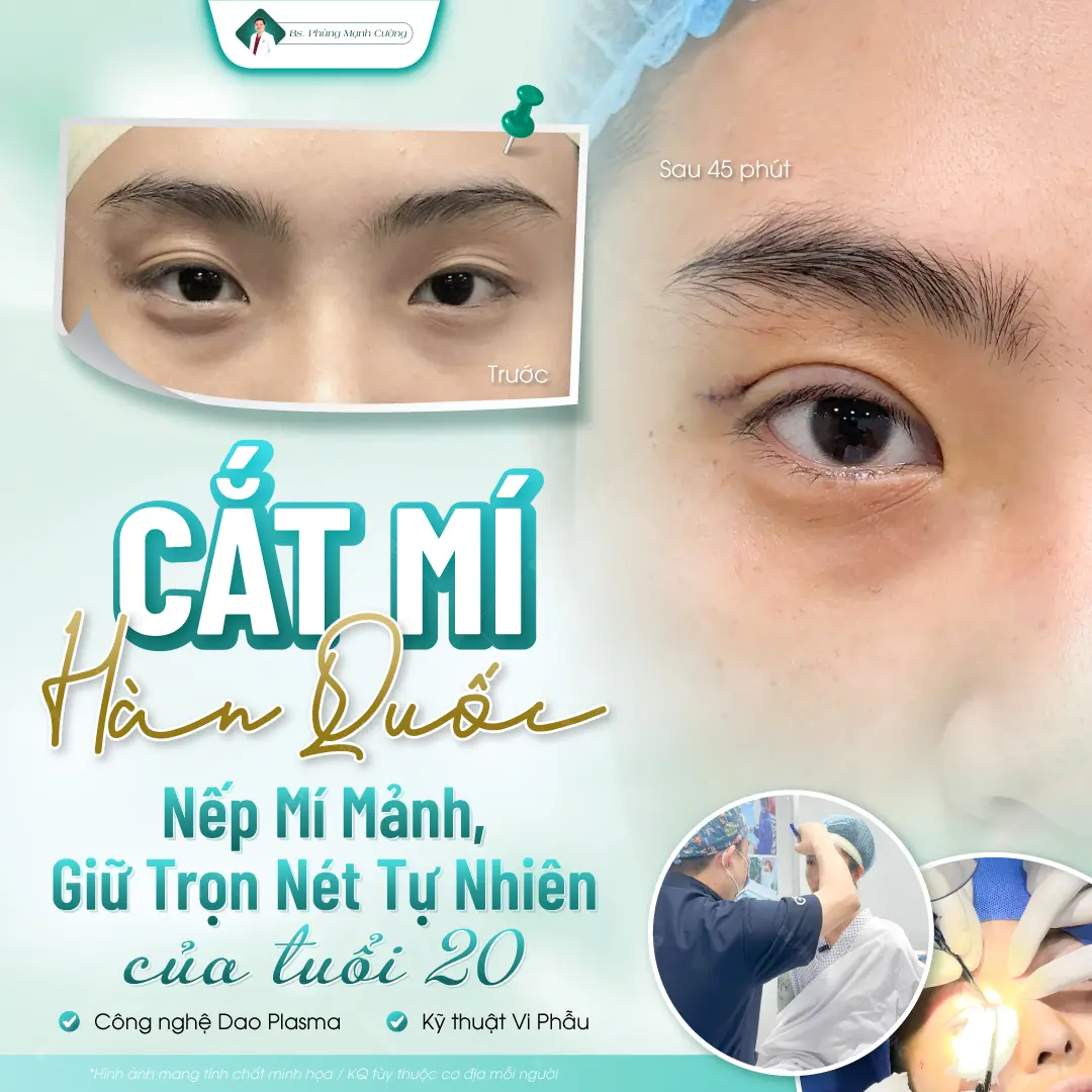 Ưu điểm vượt trội của cắt mí Hàn Quốc