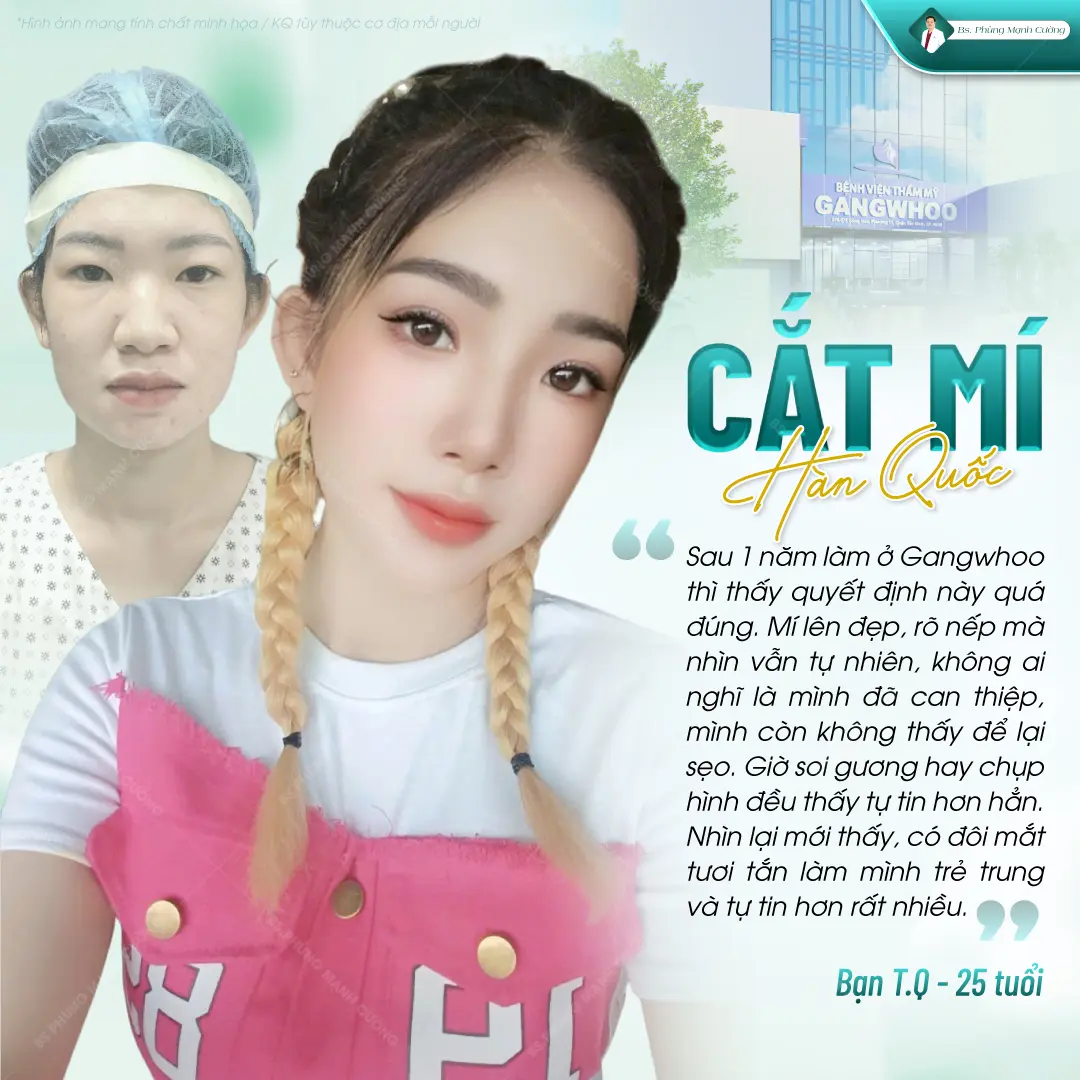 Cắt mí Hàn Quốc có nhiều ưu điểm nổi trội so với cắt mí thông thường