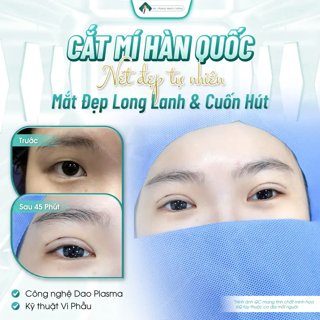 Tìm hiểu về phẫu thuật cắt mí Hàn Quốc
