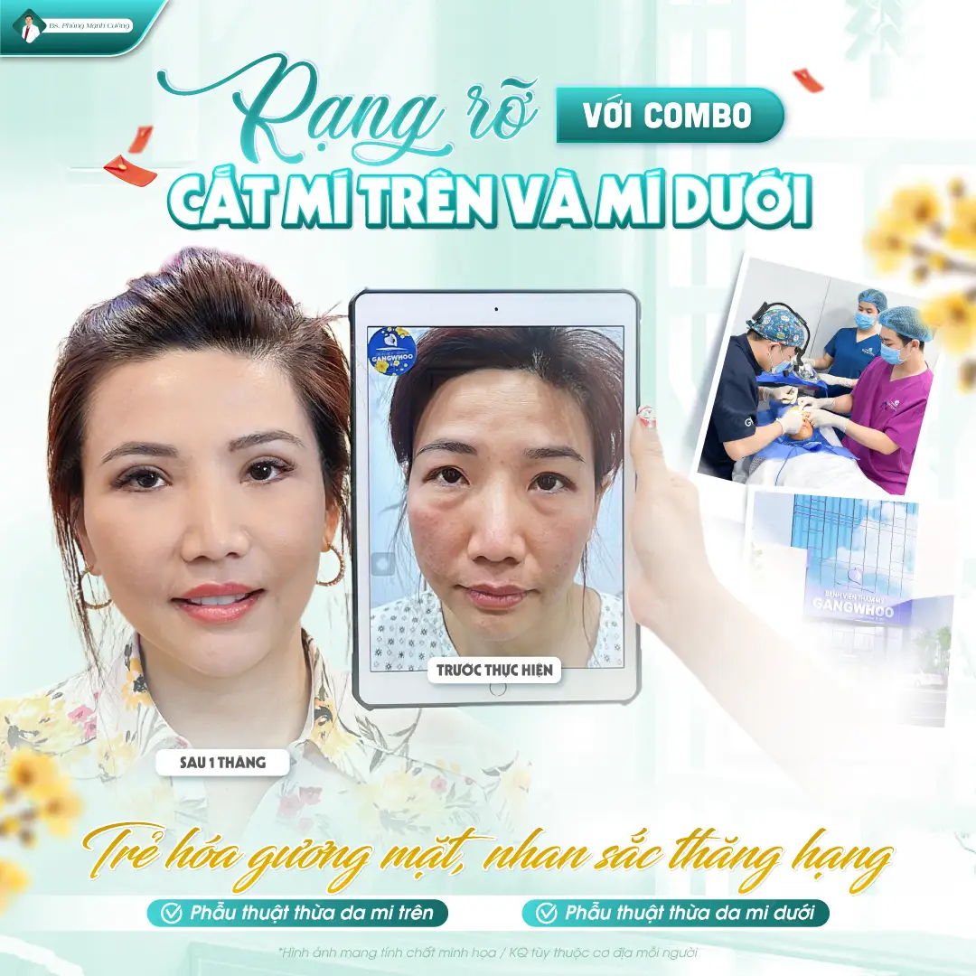 Phẫu thuật cắt da thừa mí trên và dưới mang lại ánh nhìn trẻ trung