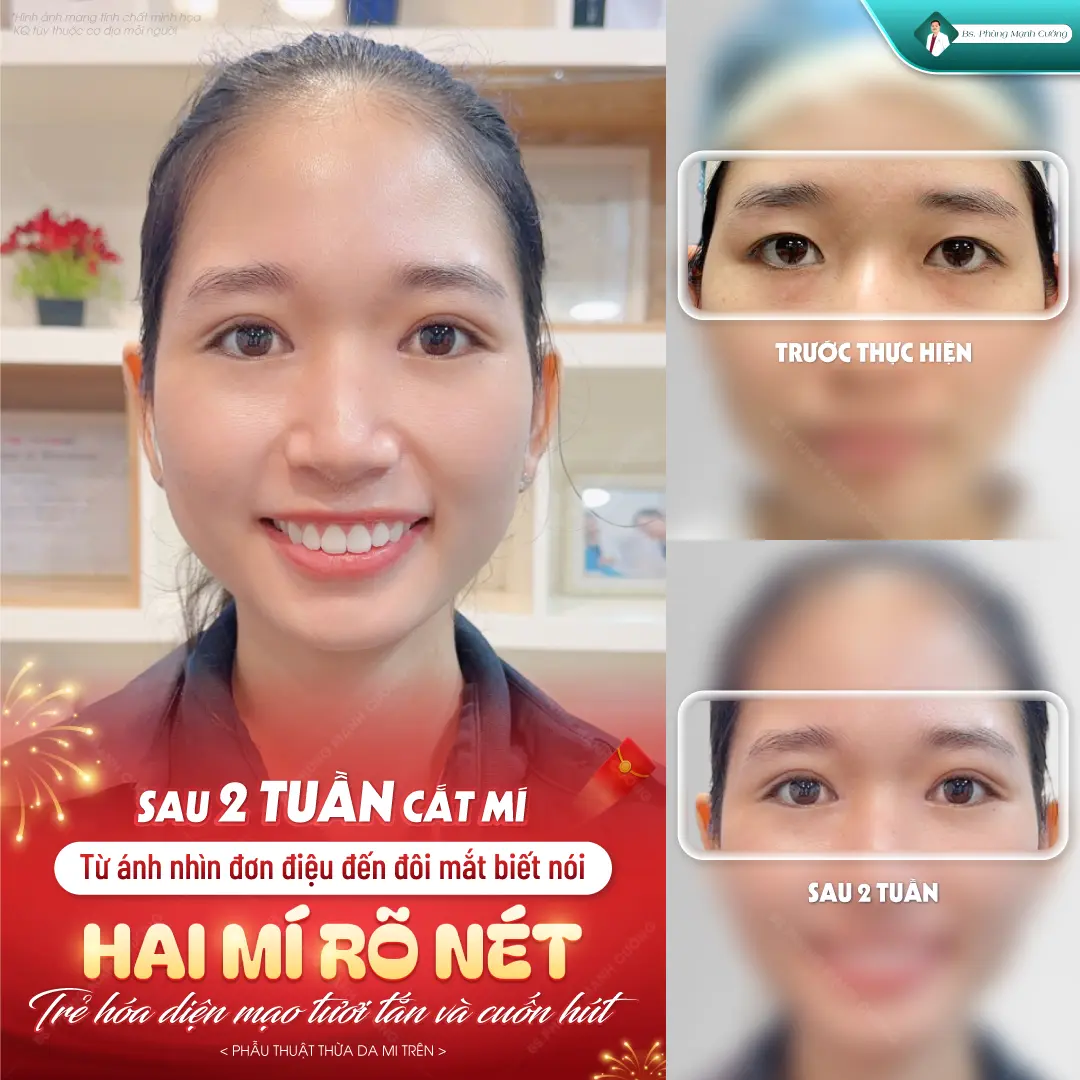 Cắt mí mắt Hàn Quốc có nhiều ưu điểm vượt trội