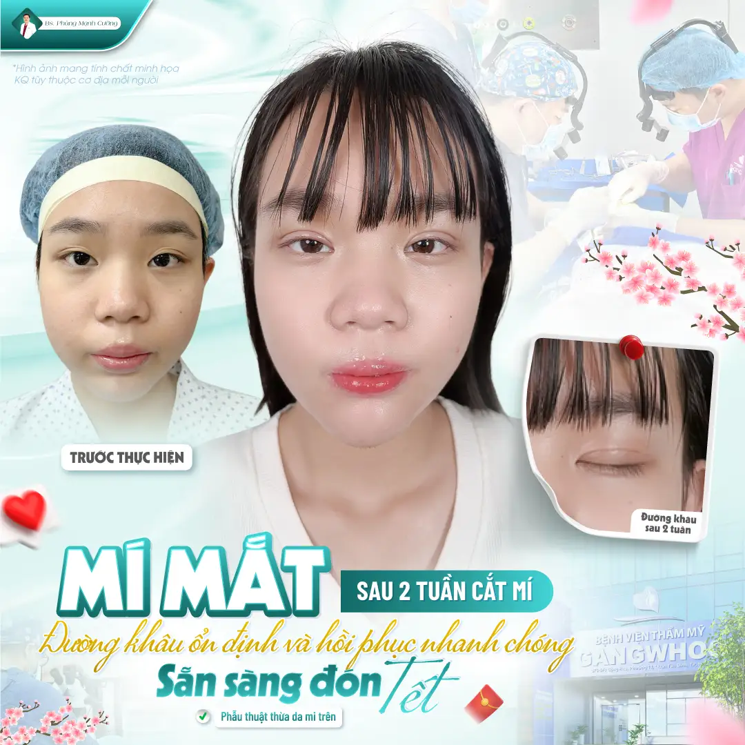 Phẫu thuật cắt mí mắt và những điều cần biết về cắt mắt 2 mí