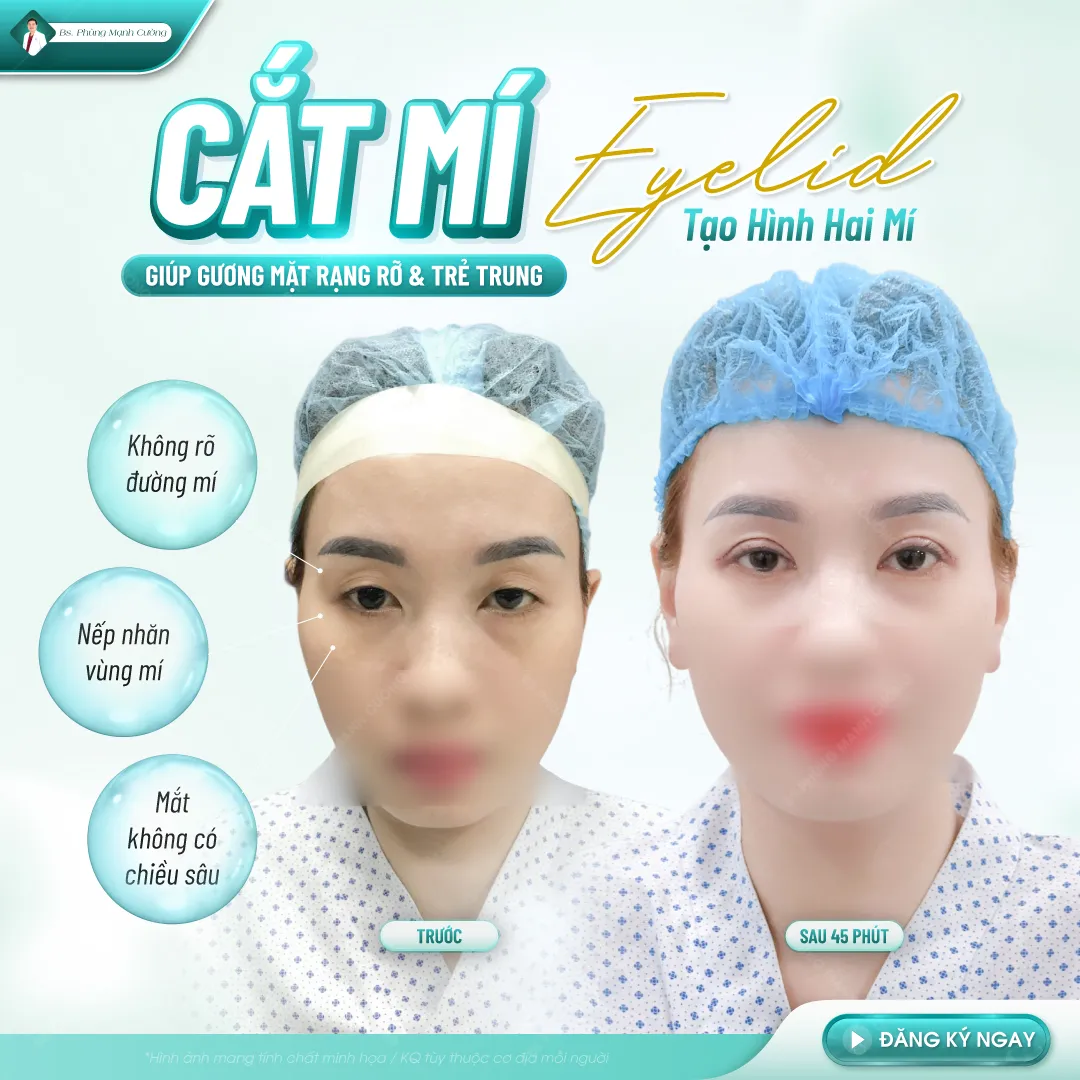 Cắt mí eyelid sở hữu nhiều ưu điểm vượt trội