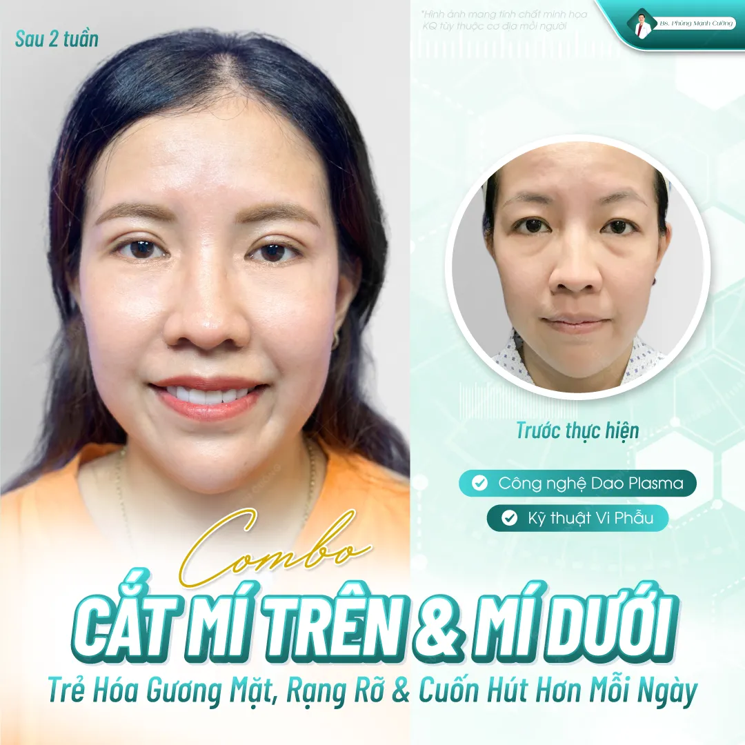 Cắt mí mắt là phẫu thuật an toàn nếu thực hiện tại cơ sở uy tín như bác sĩ Phùng Mạnh Cường