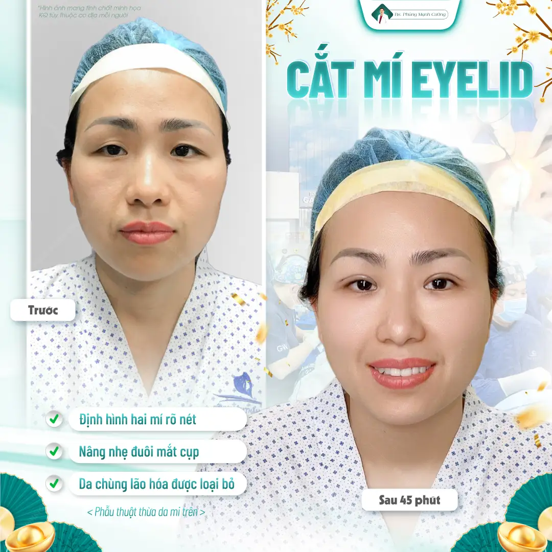 Phẫu thuật cắt mí mắt và những điều cần biết