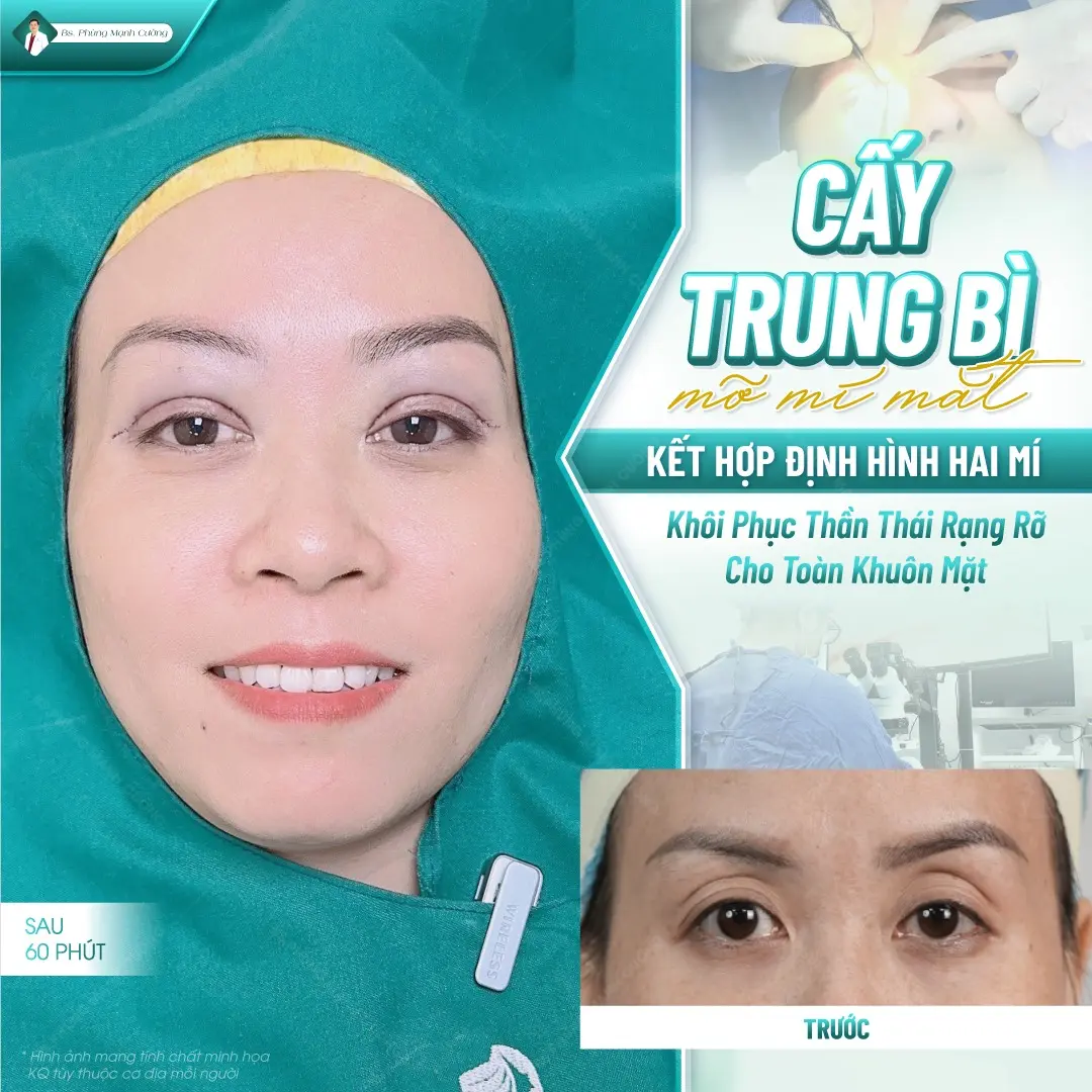 Ưu điểm của phương pháp cấy mỡ mí mắt